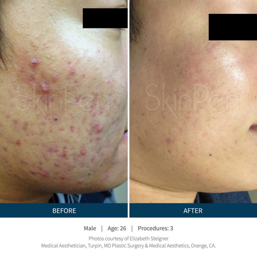 SkinPen before and after photos
