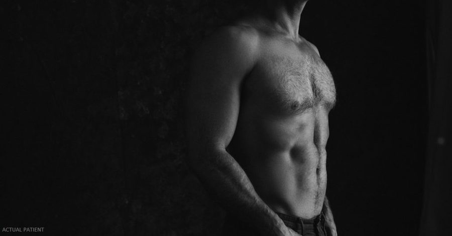 Black-and-white photo of a shirtless, muscular man's torso, labeled Actual Patient