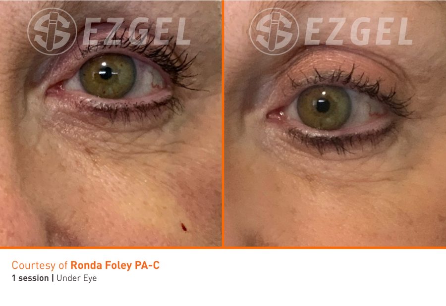 under eye results from ezGEL