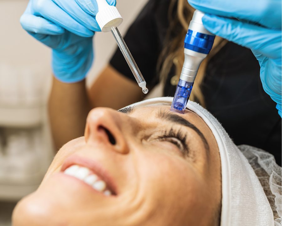 Microneedling treatment with added exosomes