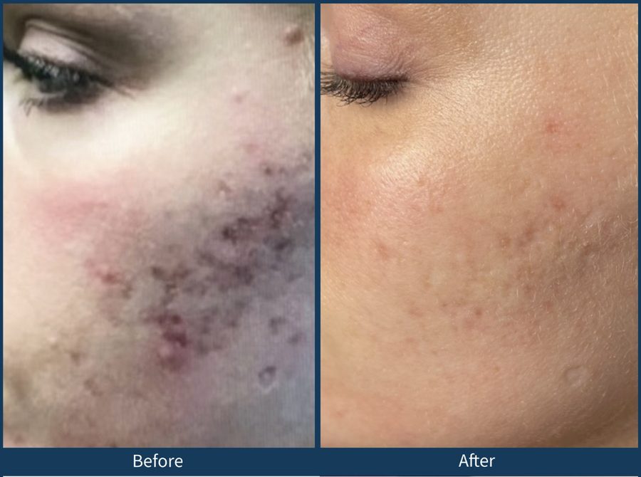Microneedling Before and After in Austin, TX