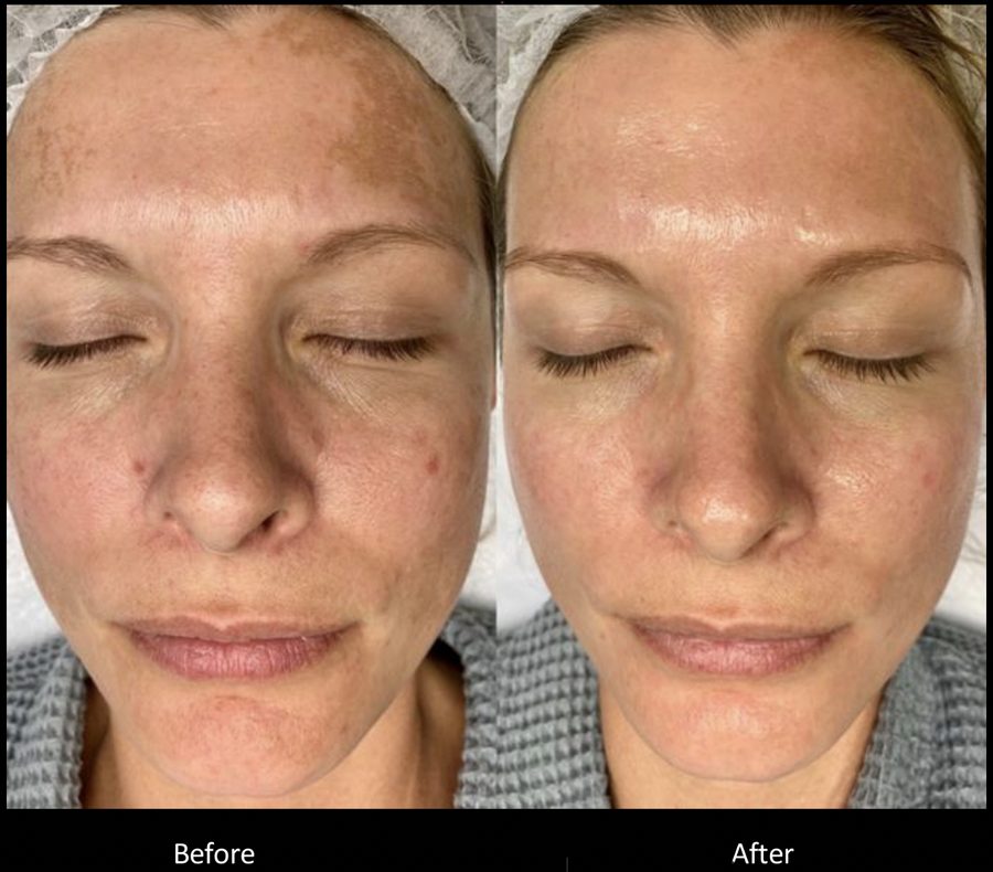 Melasma before and after moxi