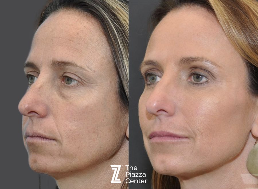 Crow's Feet with filler