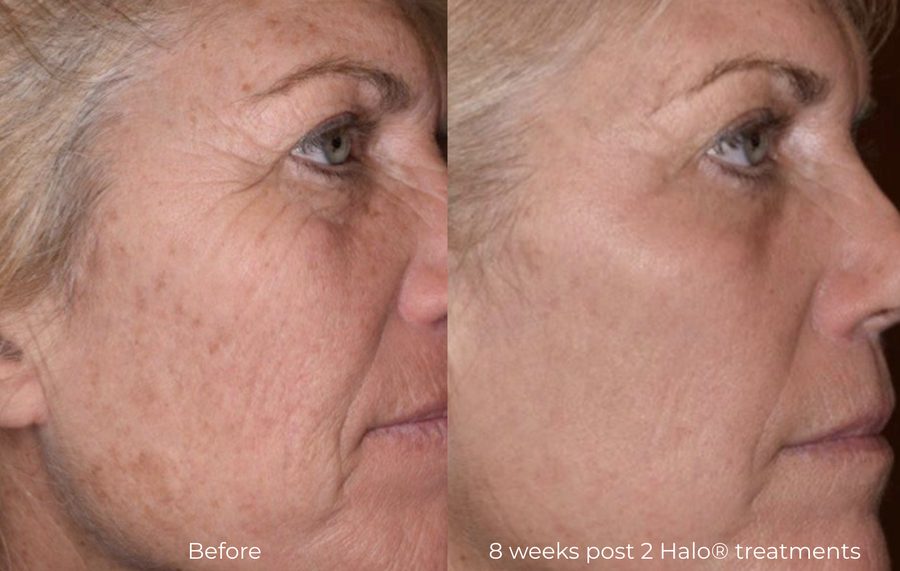 treating crow's feet with Halo laser
