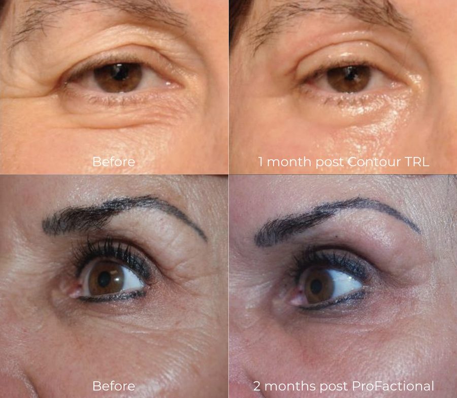 ContourTRL ProFractional eye wrinkles