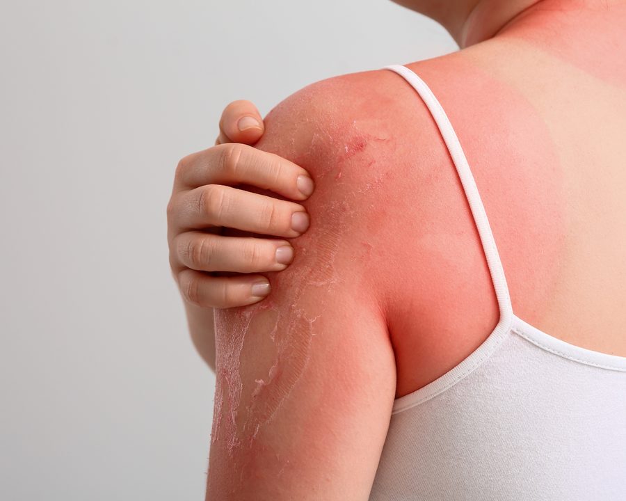 Post-Sunburn Skin Care