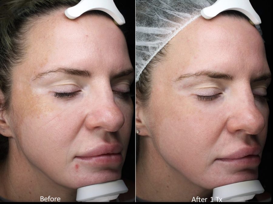 Melasma patient during Moxi laser treatment