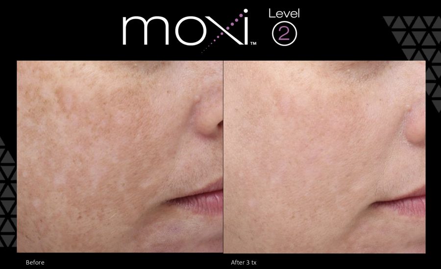 Moxi laser treatment for melasma in Austin
