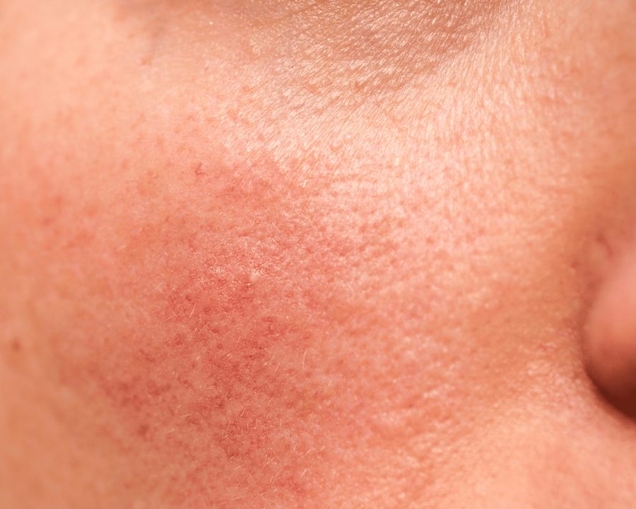Rosacea treatments