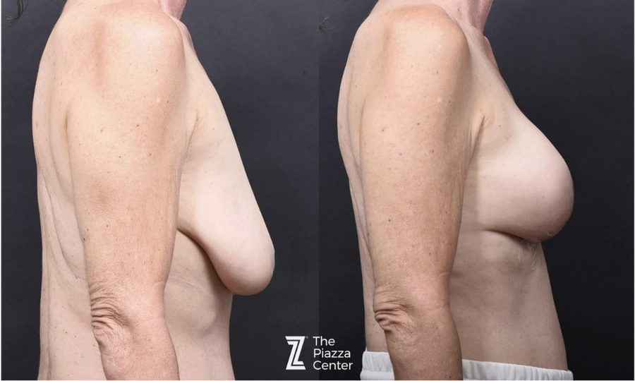 60-year-old breast lift with Motiva Preservé case study, Austin